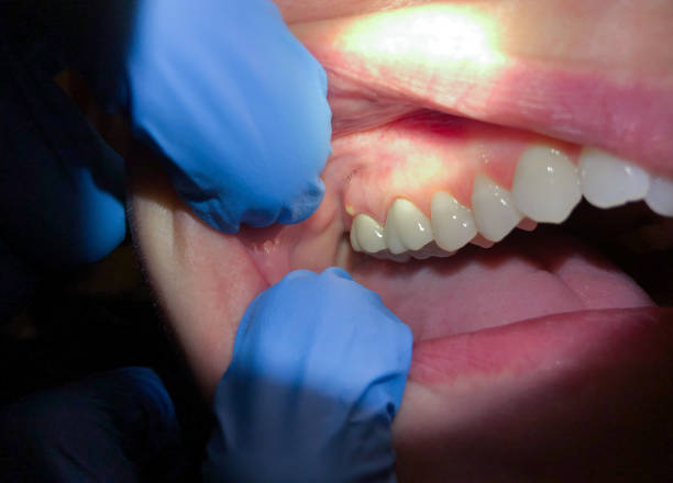 Best Emergency Wisdom Teeth Removal in Charlotte, NC